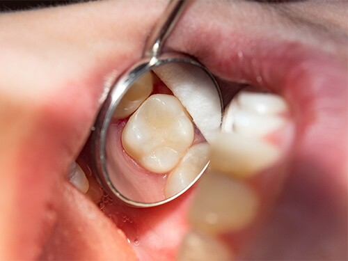 Close up of dental mirror reflecting a tooth