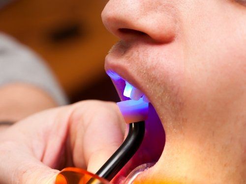 Close up of dental patient receiving cosmetic dental bonding on a tooth