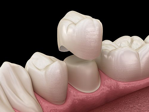 A 3D illustration of a dental crown going over a tooth