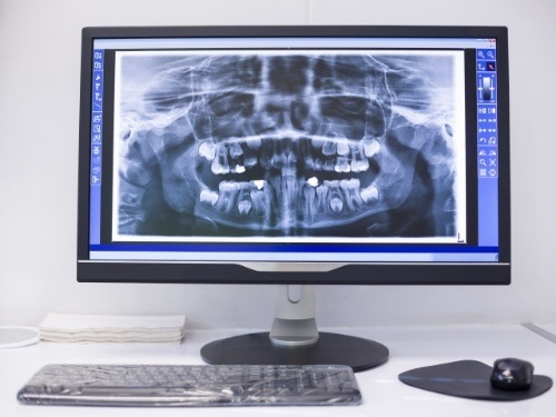 Panoramic x ray of teeth on computer screen