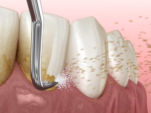 Illustrated dental instrument cleaning plaque buildup off of teeth