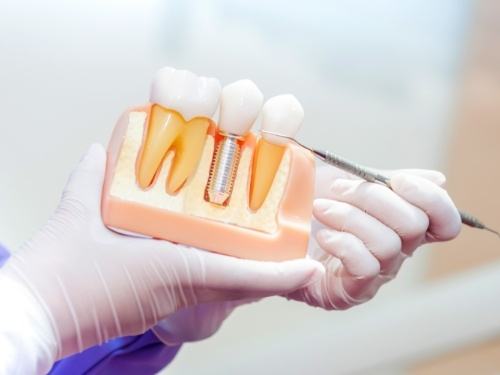 Dentist holding a model of a dental implant in the jaw