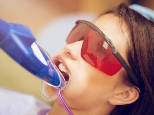 Girl with trays over her teeth for fluoride treatment