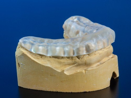 Model of lower jaw with clear nightguard over the teeth