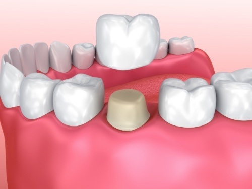 Illustrated dental crown being fitted over a tooth
