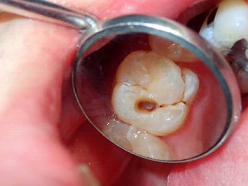 Tooth Decay on back tooth