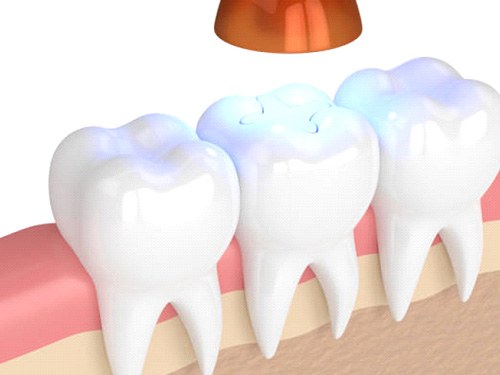 Dental light hardening filling