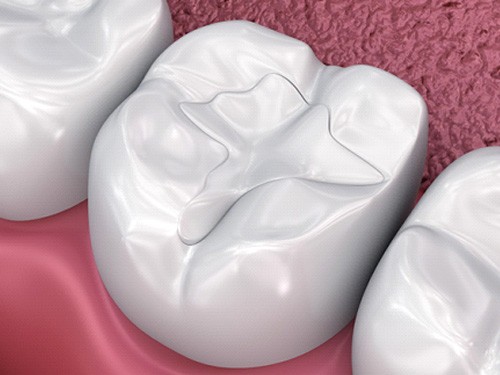 Tooth-colored filling on lower tooth