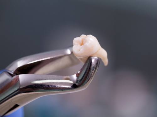 Dental forceps holding extracted tooth