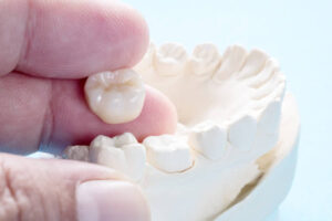 Dental model showing how a crown works